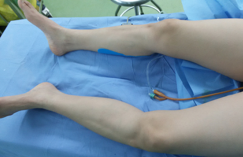 携生医疗膝关节内翻手术前