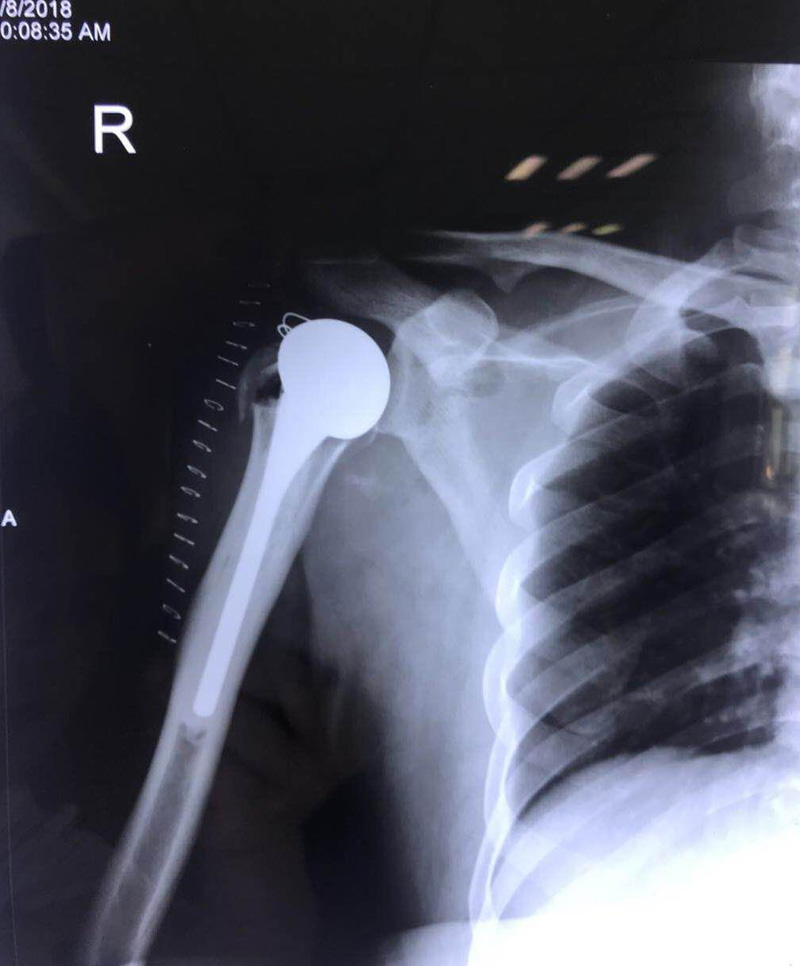 携生医疗右侧肱骨头置换手术后X光片